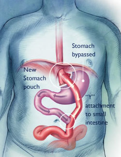 Laparoscopic Gastric Bypass